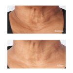 Perricone MD, Cold Plasma Plus+ Sub-D/Neck Treatment, 59ML - Image 5